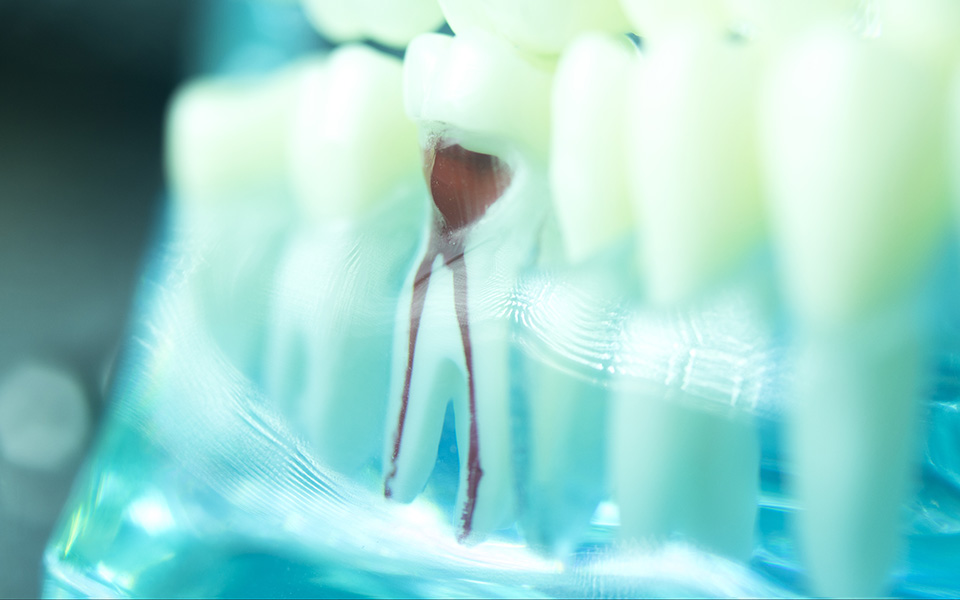 Weitere Technik für den Zahnerhalt