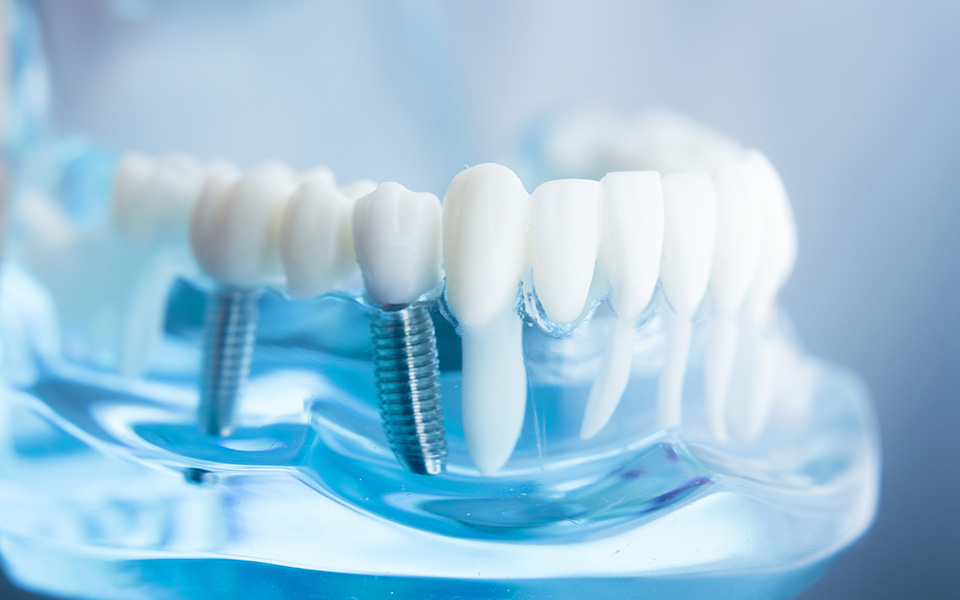 Unsere Besonderheiten in der Implantologie